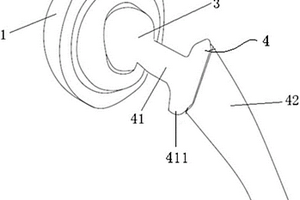 新型多孔钛人工髋关节