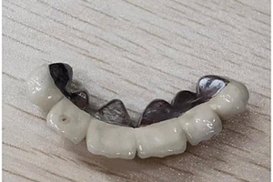 锌合金义齿3D打印方法