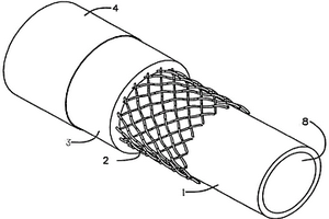 复合材料的医用导管