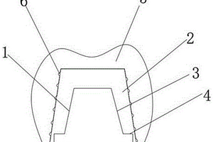 3D打印钛基复合材料义齿