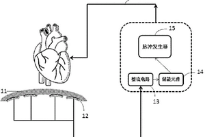 心脏起搏器