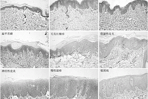 皮肤离体样本的免疫组织化学染色检测galectin-3 辅助诊断银屑病的方法