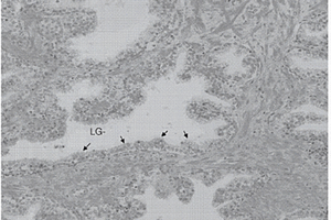 前列腺活组织检查中低级PIN(LG-PIN)中ERG基因重排和蛋白质过表达的存在