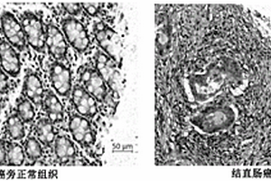 结直肠癌标志物及其应用